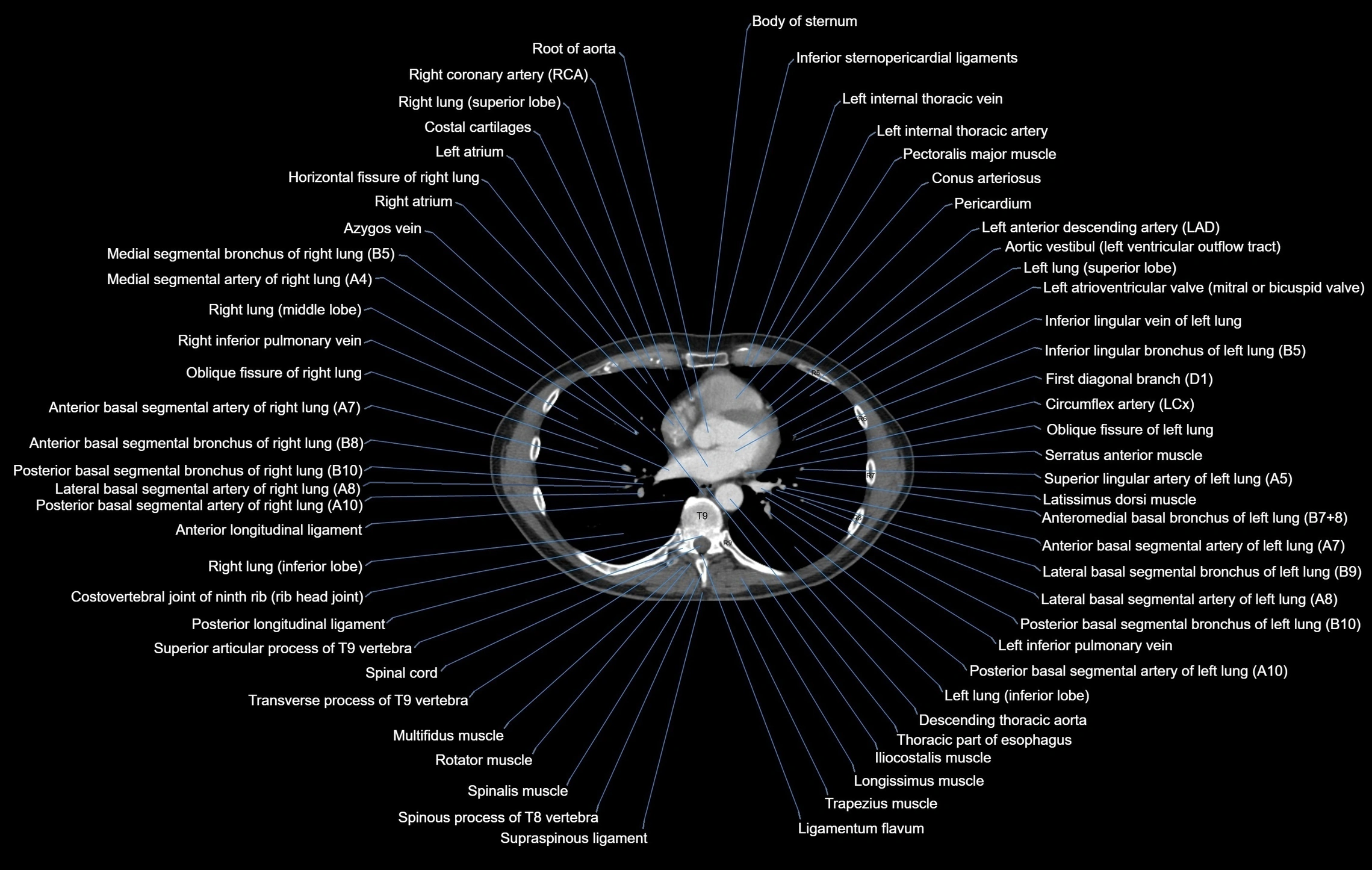 CT chest (thorax) soft tissue window labelled axial cross sectional anatomy radiology image-00074.webp